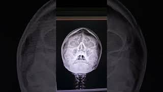 PNS XRAYparanasal sinusPNS Headdoctor Head anatomy nasal septum is deviated to right side [upl. by Kelley]