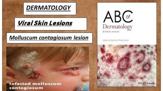 DERMATOLOGY Viral skin lesions  molluscum contagiosum lesions derma lesion viral [upl. by Cand530]