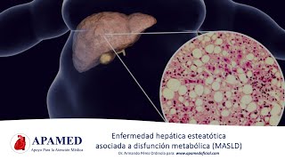 Esteatosis hepática asociada a disfunción metabólica MASLD NAFLD [upl. by Ivatts]