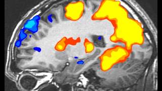 fMRI BrainScan SideView [upl. by Esmaria709]