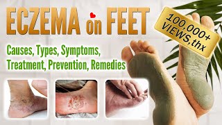 Eczema on foot Causes Symptoms Types Treatment Prevention and Home Remedies  Feet Eczema [upl. by Carlynne421]