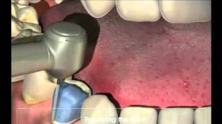 Crowns  Procedure for your new crown at Dental Reflections [upl. by Lengel]