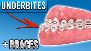 How Do Braces Fix Underbites  Premier Orthodontics [upl. by Publia]