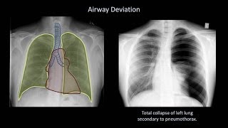 How to Interpret a Chest XRay Lesson 4  Airways Bones and Soft Tissues [upl. by Ydna325]