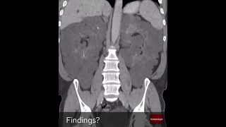 Coronal slices of an abdominal CT From The Radiologist [upl. by Erdreid]