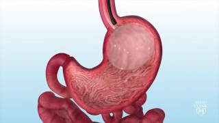 Intragastric Balloon for Weight Loss  Mayo Clinic [upl. by Ainedrag]