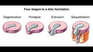 Physiotherapy for Intervertebral Disc prolapse StayHome and study WithMe [upl. by Ezara]