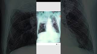 X ray of Bronchial carcinoma mass lesion [upl. by Disini]