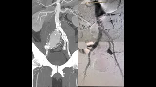 Elective endovascular aortic repair EVAR in Tashkent Uzbekistan [upl. by Ric]