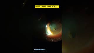 INTRAOCULAR FOREIGN BODY eyes OCULAR TRAUMA [upl. by Gerc]