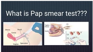 An overview of Pap smear test [upl. by Windzer]