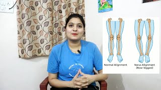 Bow Legs Physiotherapy Treatment  Exercises for GENU VARUS  Exercises for Bow Legged People Hindi [upl. by Shoshanna733]