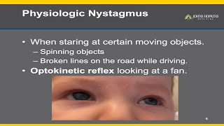 Nystagmus  A Patient Guide [upl. by Huntingdon]