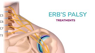 Erbs Palsy Treatment in Newborn [upl. by Nylanaj]