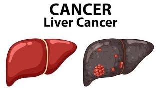 LIVER CANCER BSC NURSINGdailypost [upl. by Llenrrad]