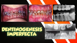 DEVELOPMENTAL ANAMOLIES OF TEETH  DENTINOGENESIS IMPERFECTA [upl. by Sawtelle600]