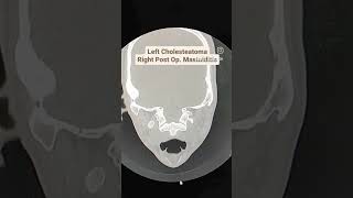 Cholesteatoma with Mastoiditis CT Temporal Bones [upl. by Shari]