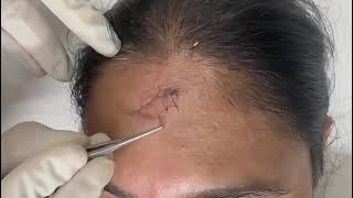 Right and easy way of suture removal [upl. by Bernadina]