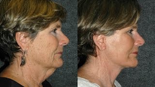 Face Lift Before and After NYC 60 year old woman  Dr Andrew Jacono Facelift minifacelift [upl. by Acceb]