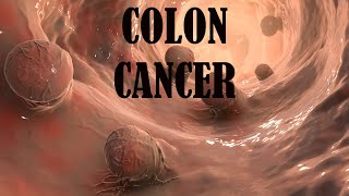 Colon Cancer A Silent Threat for Seniors [upl. by Chalmers112]