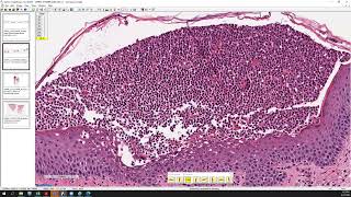 Acute generalized exanthematous pustulosis AGEP pustular psoriasis and SneddonWilkinson [upl. by Eanrahs]