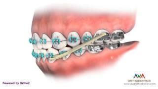 Orthodontics Treatment for Underbite or Crossbite  Rubber Bands [upl. by Katrinka]