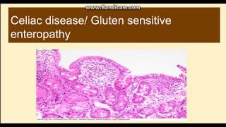 Celiac diseaseGluten Sensitive Enteropathy [upl. by Aihn309]