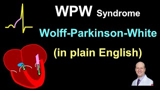 WPW Explanation and Treatment  in Plain English [upl. by Mit84]