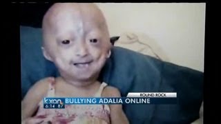 Cyber bullying of child with rare disease [upl. by Sana]