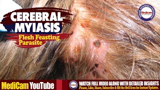 Flesh Feasting Parasite  Pathophysiology of Cerebral Maggots Myiasis [upl. by Reg]