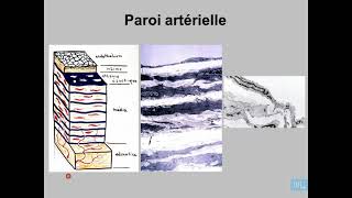 1  Athérosclérose Anatomie Pathologique Partie 1 [upl. by Esmond]