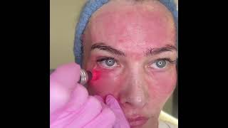 Microneedling Technique  Under Eye [upl. by Wooldridge753]