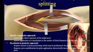 Humeral Shaft Fractures 2  Surgical techniques OTA lecture series III u04b [upl. by Teador]