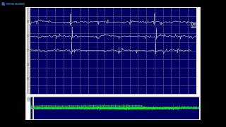 Kimura amp Kohara F21 positive sharp waves and fibrillation potentials each firing regularly [upl. by Assen347]