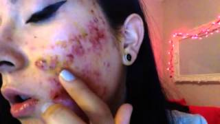 Severe cystic acne accutane week 1 [upl. by Holmes583]