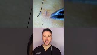 Ingrown hair extraction shorts [upl. by Gnilrad]