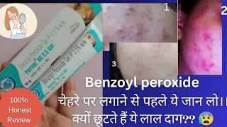 benzoyl peroxide gel 25  benzoyl peroxide gel Persol AC 25 review gel acne skincare [upl. by Asare]