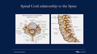 Multiple Sclerosis and the Spinal Cord [upl. by Anerres]