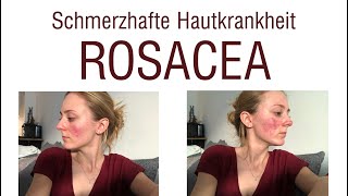 Wie ich meine Rosacea geheilt habe  LaserTherapie [upl. by Noerb130]