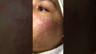 Cystic acne and blackheads removal  Newest pimple pops for 2022 [upl. by Ellednahc]