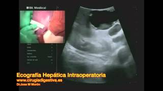 Ecografia Hepática Intraoperatoria Intraoperative Liver Ultrasound [upl. by Paulsen757]