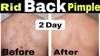 How to Remove Back Acne and PimplesGet Rid of Back amp Body Acne PimpleBack acne treatment [upl. by Lessig]