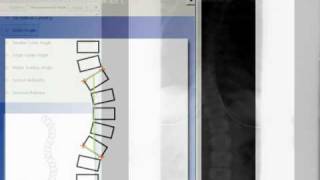 TraumaCad  Cobb Angle [upl. by Abekam]