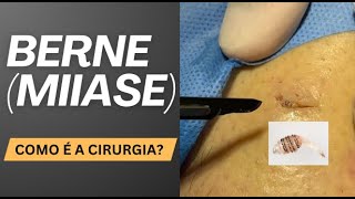 Miíase berne o que é Como é a cirurgia Por Dr Luiz Gameiro dermatologista [upl. by Nuahsak]