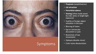 Thyroid Eye Disease [upl. by Ena]