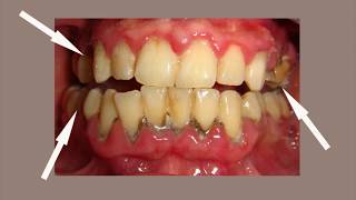 Periodontitis Treatment  Miracle Cure of Gum Disease and Periodontitis [upl. by Morrissey]