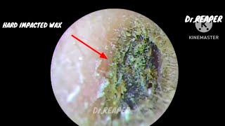 SATISFYING HARD IMPACTED EAR WAX REMOVAL IS IT INFECTED OR NORMAL 🙄🙄 [upl. by Eiramaliehs]