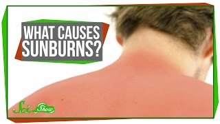 What Causes Sunburns [upl. by Alleynad895]