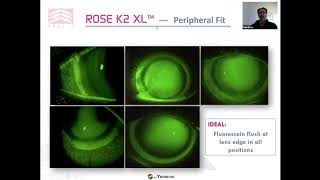 Webinar Menicon Como adaptar Rose K2 XL Com Paul Rose inglês [upl. by Peck]