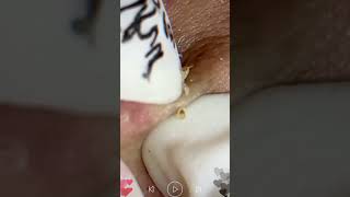 Skincare  Blackheads Removal 221 squeeze squeeze blackheads blackheads [upl. by Eceined302]